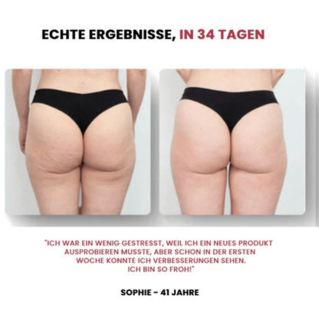 Mynera™ Anti - Cellulite Cupping Massage - Stilvivo™